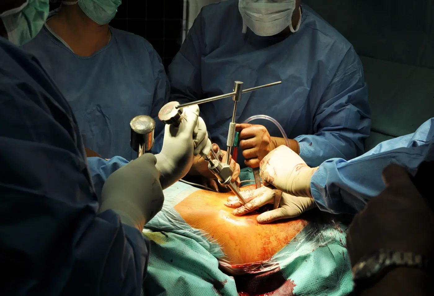 Hip and Knee Joint Replacement Surgery